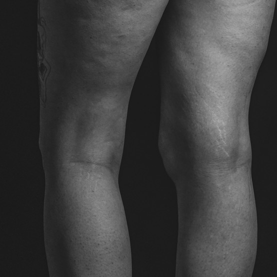 Corps d'une femme avec des vergetures sur l'arrière des genoux