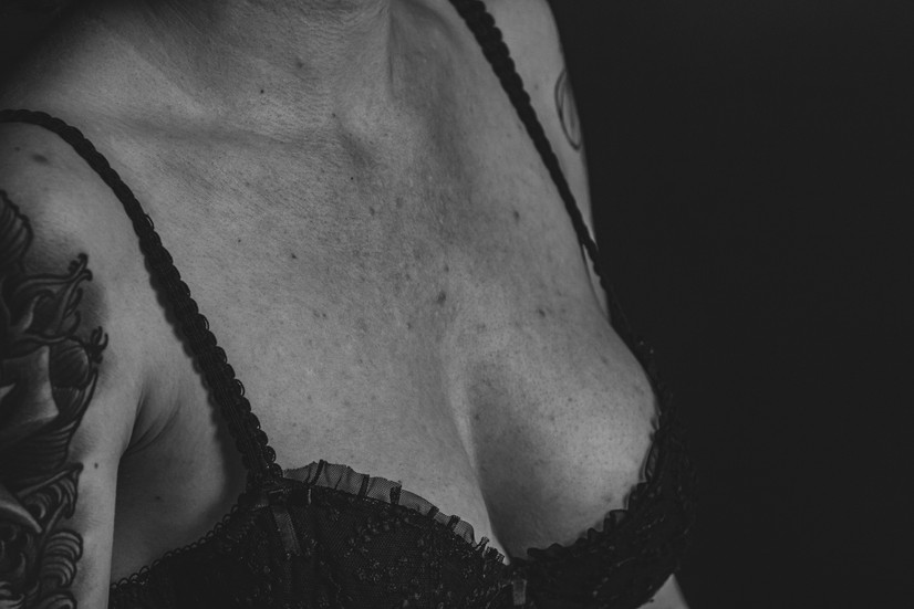 Corps d'une femme avec de l'acné sur le haut de la poitrine