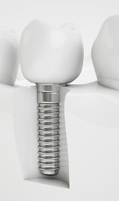 Restorative Dentistry_edited.jpg