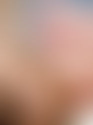 MENINGITE C TEM MAIS UMA MORTE CONFIRMADA NO SUL DE MINAS