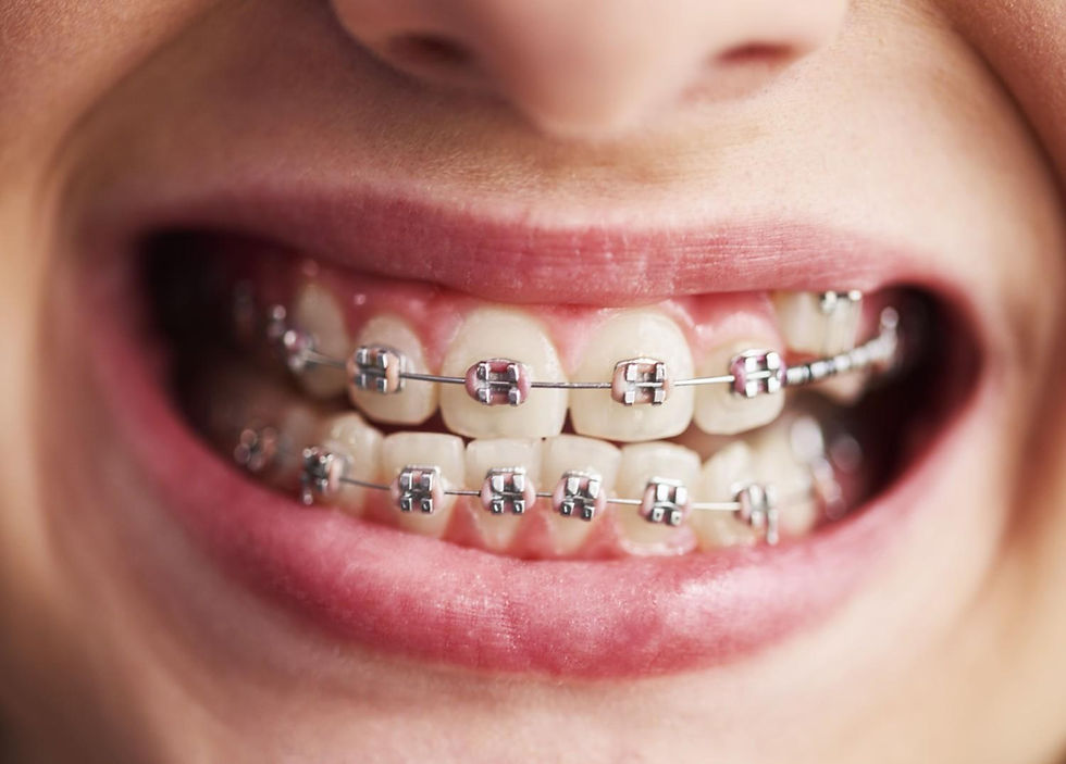 Close-up of a patient smiling showing metal braces on upper and lower teeth during orthodontic treatment