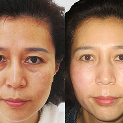 Bio Living Cell facial contour facial skin rejuvenation pigmentation