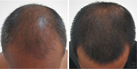 Victory wellness blc therapy natural male hair loss treatment.jpg