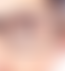 Dấu hiệu kính lệch tâm: Nhận biết sớm để bảo vệ thị lực