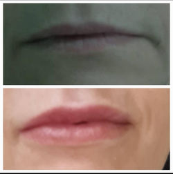 Preenchimento Labial