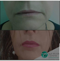 Preenchimento Labial