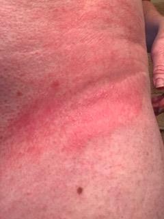 rash3