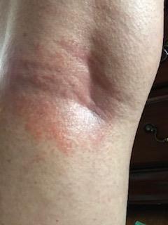 rash6