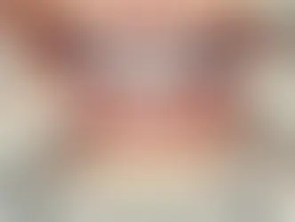 Lentes de Contato Dentais: Porcelana ou Resina? Descubra qual é a Melhor Opção
