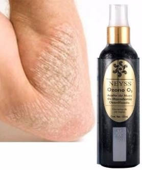 La vida diaria y aceptar mi Psoriasis