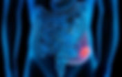 Cancer de Colon: segunda causa de muerte a nivel mundial.