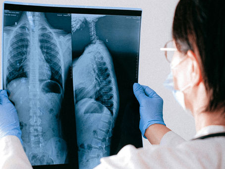 La tos es un fenómeno clínico complejo que se relaciona con mecanismos respiratorios, inflamatorios, neurológicos, inmunológicos e incluso sistémicos.