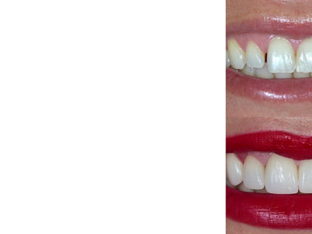 Alguns sorrisos Lilibeth Andrade...Antes e depois!