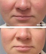 mandelic acid before after.jpg