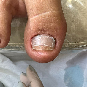 PODÓLOGA IVANE MORAIS | UNHAS ENCRAVADAS | PÉS DIABÉTICOS | OLHO DE PEIXE | MICOSSE | FISSURAS | CALOS E CALOSIDADES | SOROCABA/SP