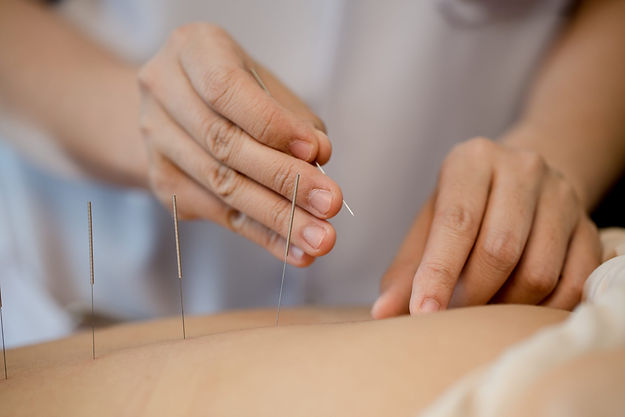 Dry Needling .jpeg