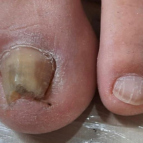 PODÓLOGA IVANE MORAIS | UNHAS ENCRAVADAS | PÉS DIABÉTICOS | OLHO DE PEIXE | MICOSSE | FISSURAS | CALOS E CALOSIDADES | SOROCABA/SP