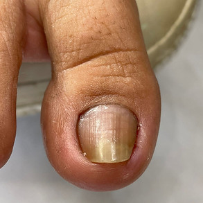 PODÓLOGA IVANE MORAIS | UNHAS ENCRAVADAS | PÉS DIABÉTICOS | OLHO DE PEIXE | MICOSSE | FISSURAS | CALOS E CALOSIDADES | SOROCABA/SP