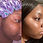 Thumbnail: Mud Mask Acne Killer