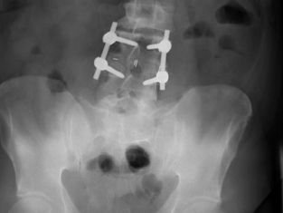 Is Chiropractic Care Recommended After Surgery?