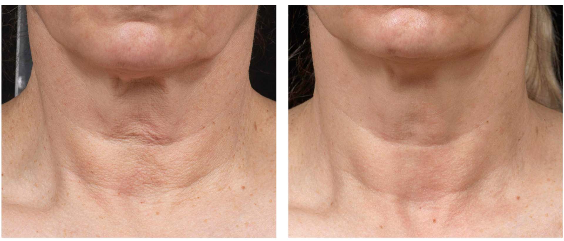 Fraxel Laser Honolulu Hawaii