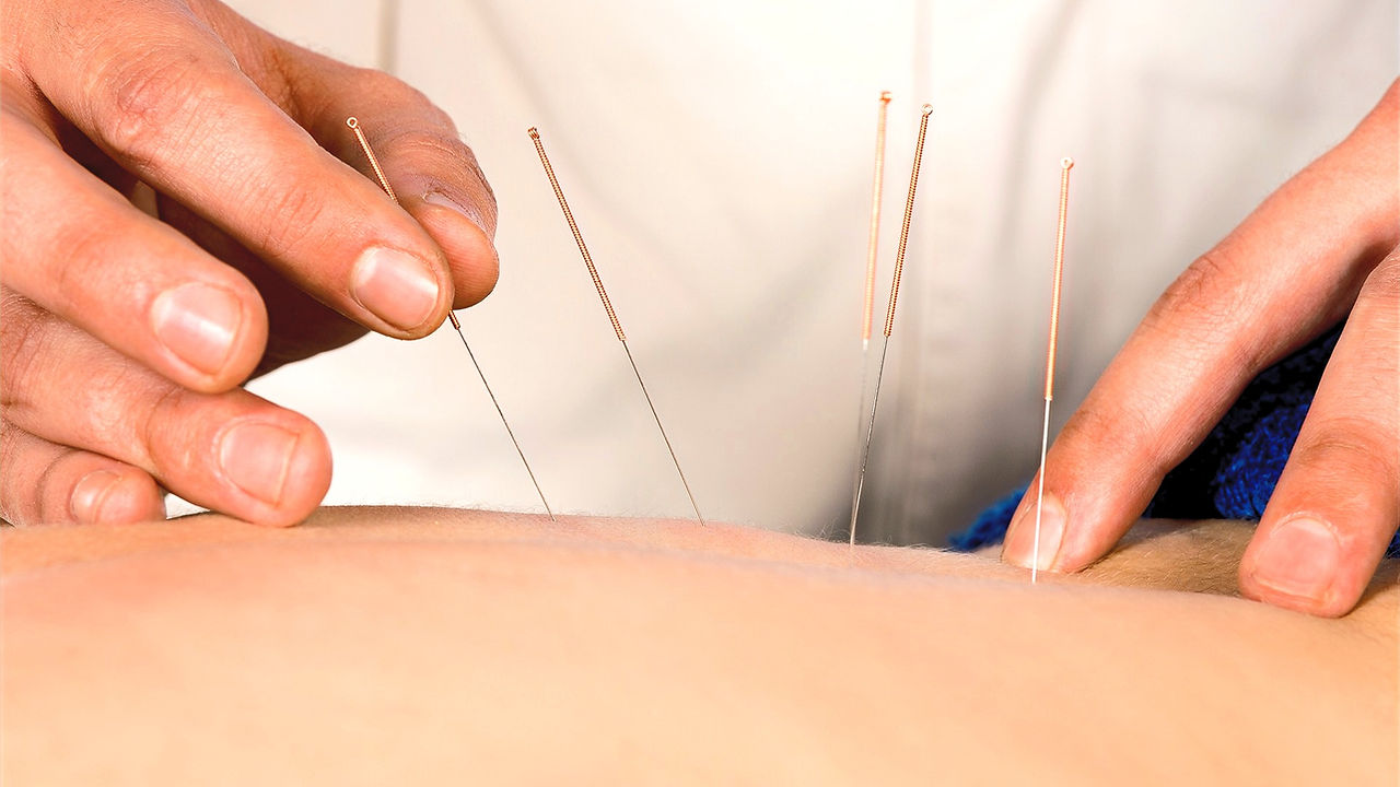 Acupuncture_edited.jpg