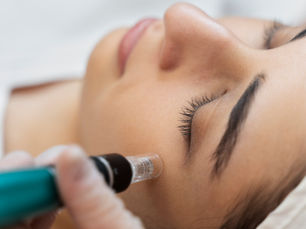 Everything You Need to Know About Microneedling: The Powerhouse for Skin Transformation