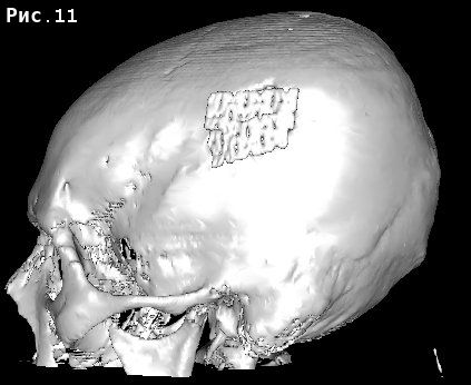 3D-реконструкция в программе MITO на основе послеоперационной КТ.