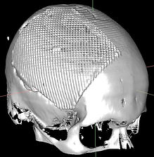пластика дефекта свода черепа пластиной Conmet, 3D-реконструкция, нейрохирург Тихомиров