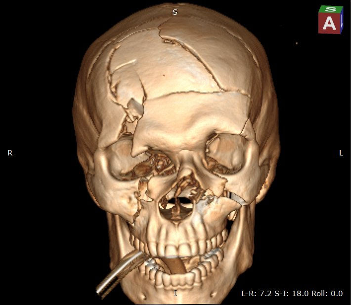 КТ головного мозга. 3d реконструкция
