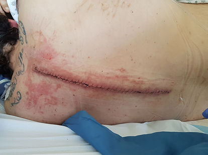 The incision in my back- which was over 50 stiches