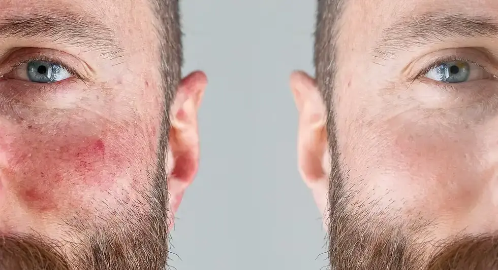 rosacea.webp