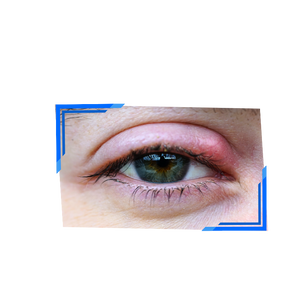 Todo sobre los orzuelos y cómo tratarlos