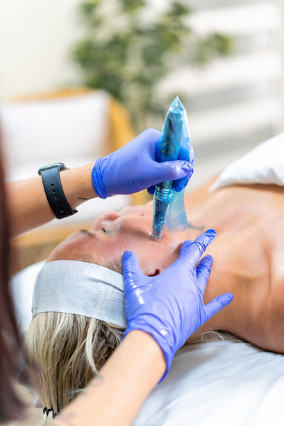 Microneedling (7 of 11).jpg
