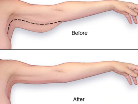 LIFTING DE BRAZOS O "BRAQUIOPLASTIA"