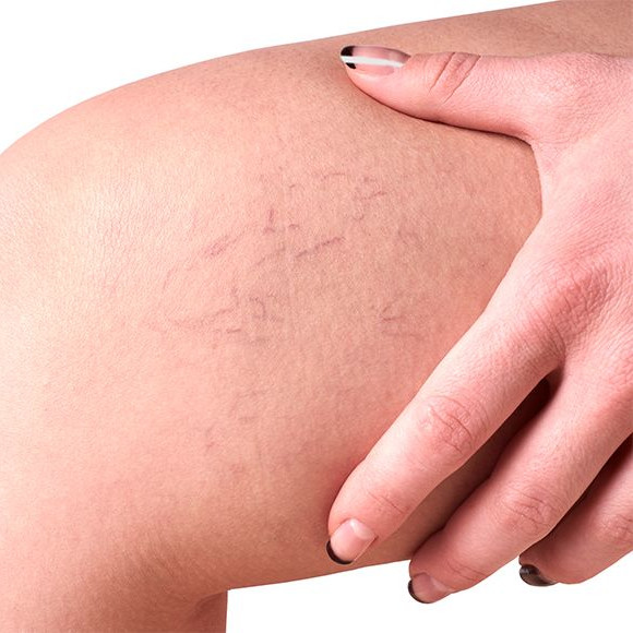 Escleoterapia (aplicação) é Ideal para tratamento de vasinhos, tecnicamente chamados de telangectasias.