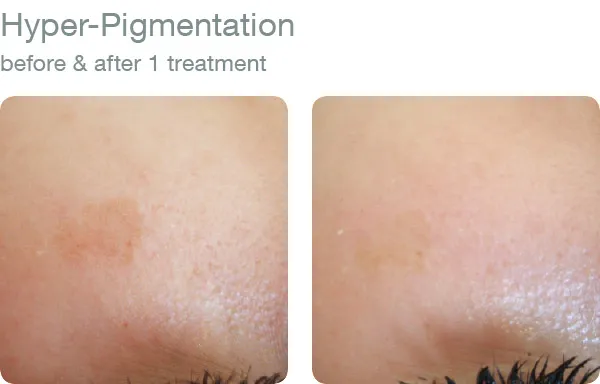 elapromed_07_hyper_pigmentation.jpg.webp