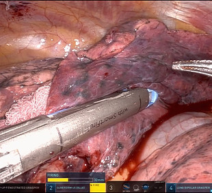 Robotic Lung Wedge Resection