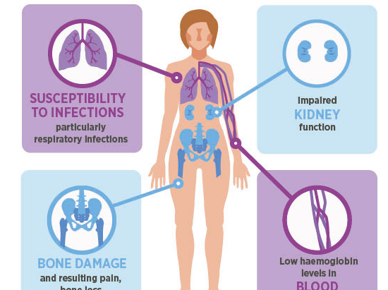 Multiple Myeloma: Symptoms & Diagnosis