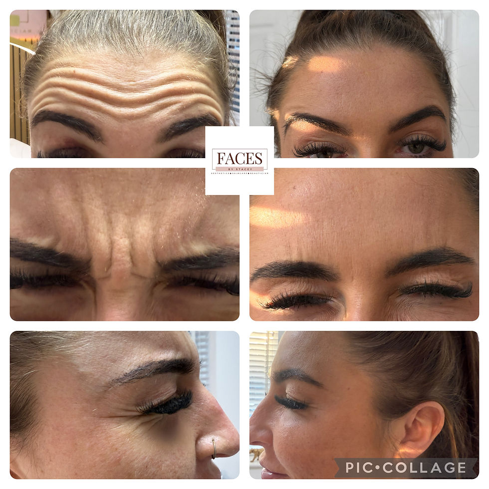 Thumbnail: anti wrinkle 3 areas