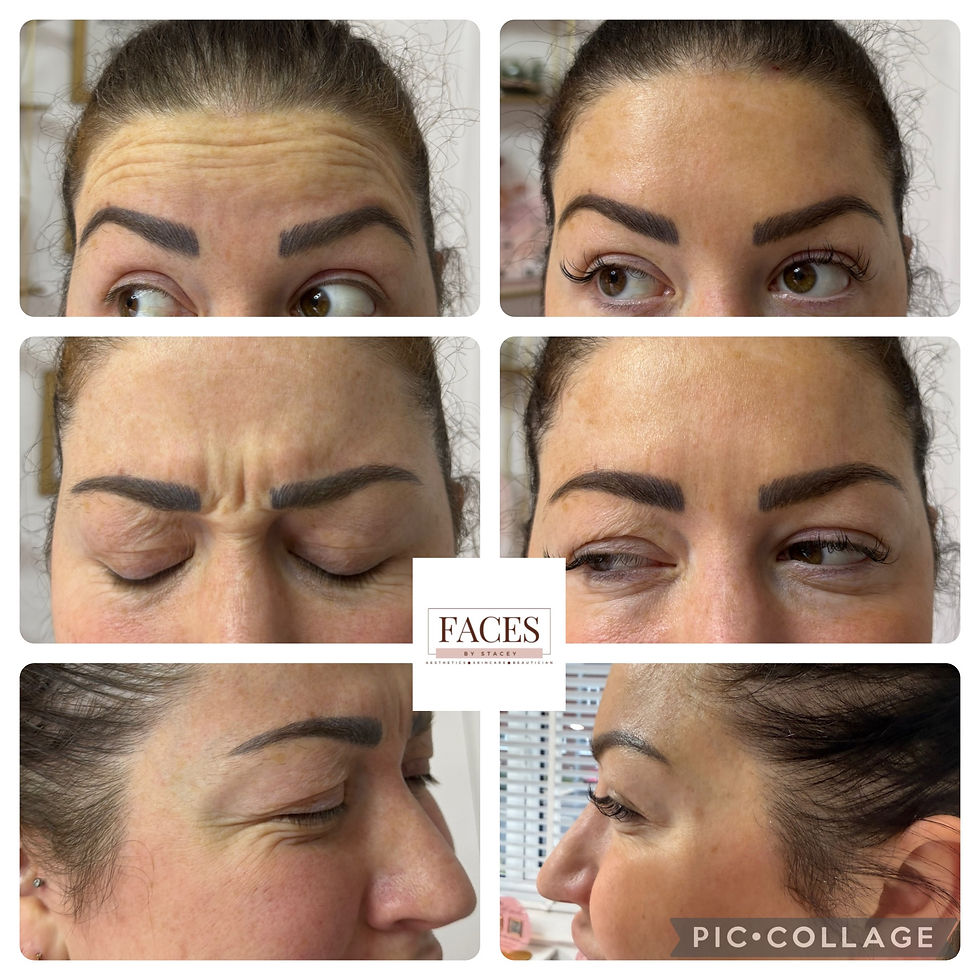 Thumbnail: anti wrinkle 3 areas