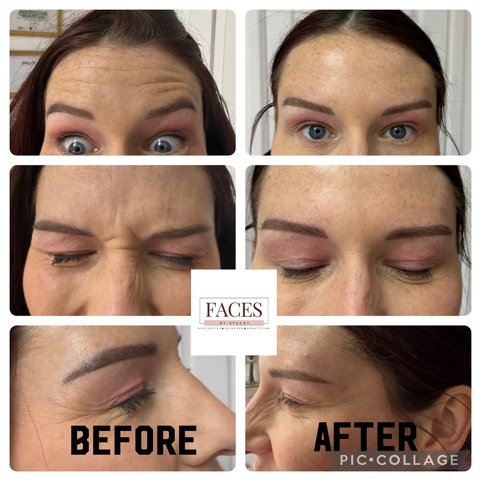 Thumbnail: anti wrinkle 3 areas