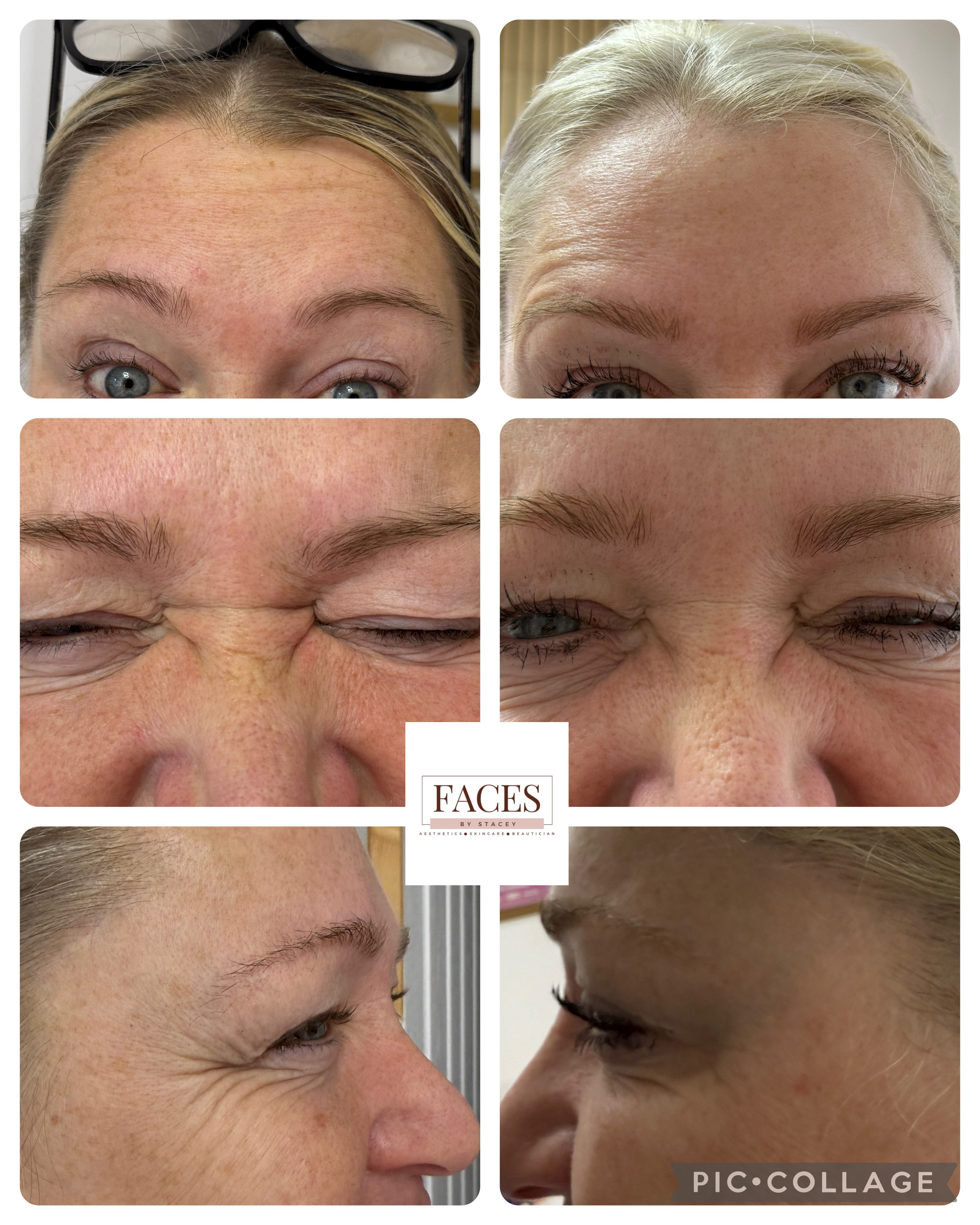 anti wrinkle 3 areas