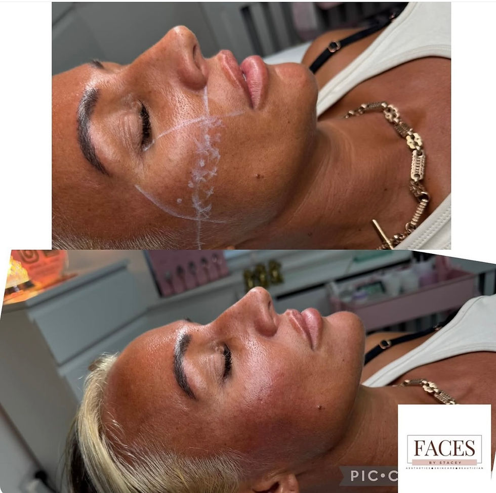 Thumbnail: cheek filler 1.1ml per ml 