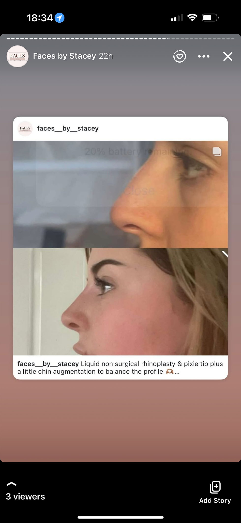 Thumbnail: non surgical liquid rhinoplastary with pixie tip