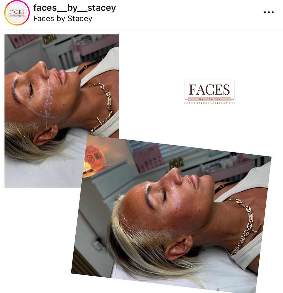 Thumbnail: cheek filler 1.1ml per ml 