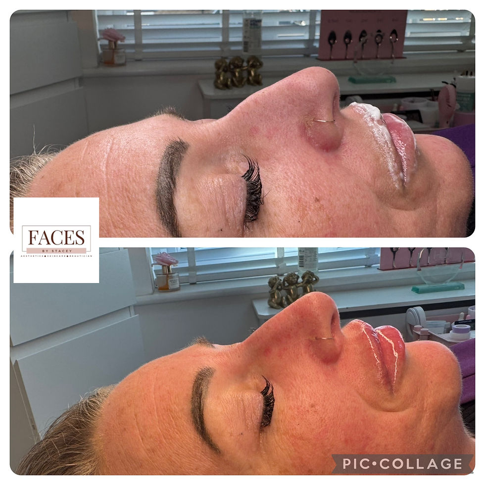 Thumbnail: non surgical liquid rhinoplastary with pixie tip