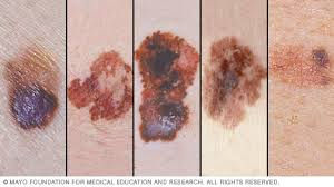 melanoma.jpeg
