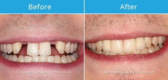 Case Studies Dental Implants Bedford