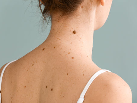 The Importance of Regular Skin Checks: Detecting Skin Cancer Early